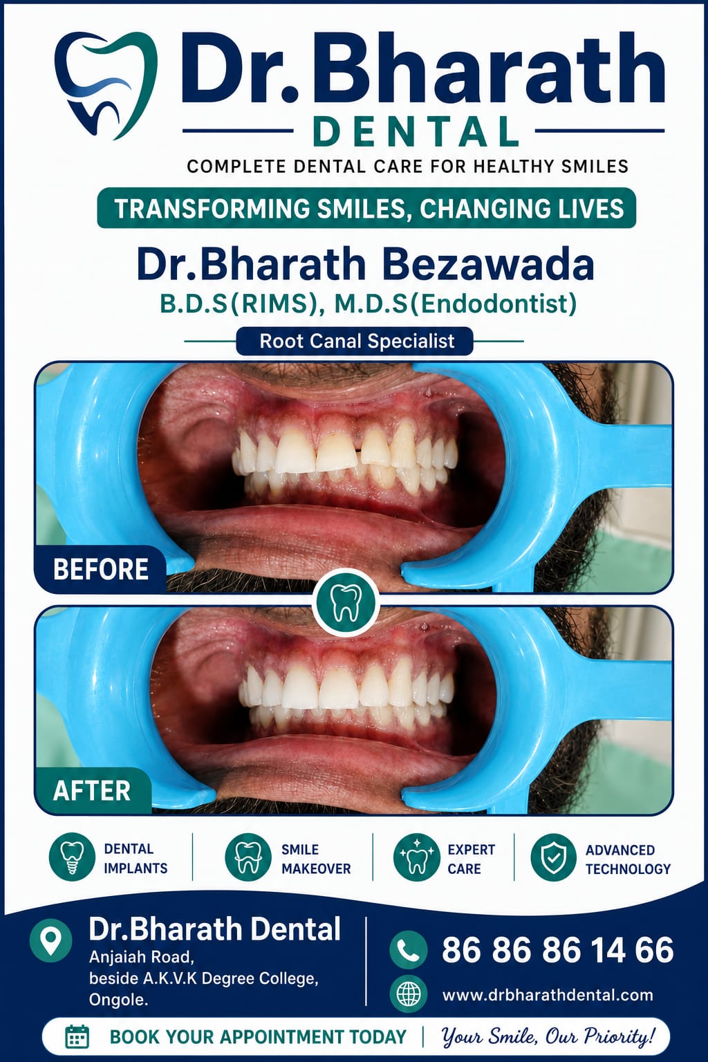 Dental Implants Before and After